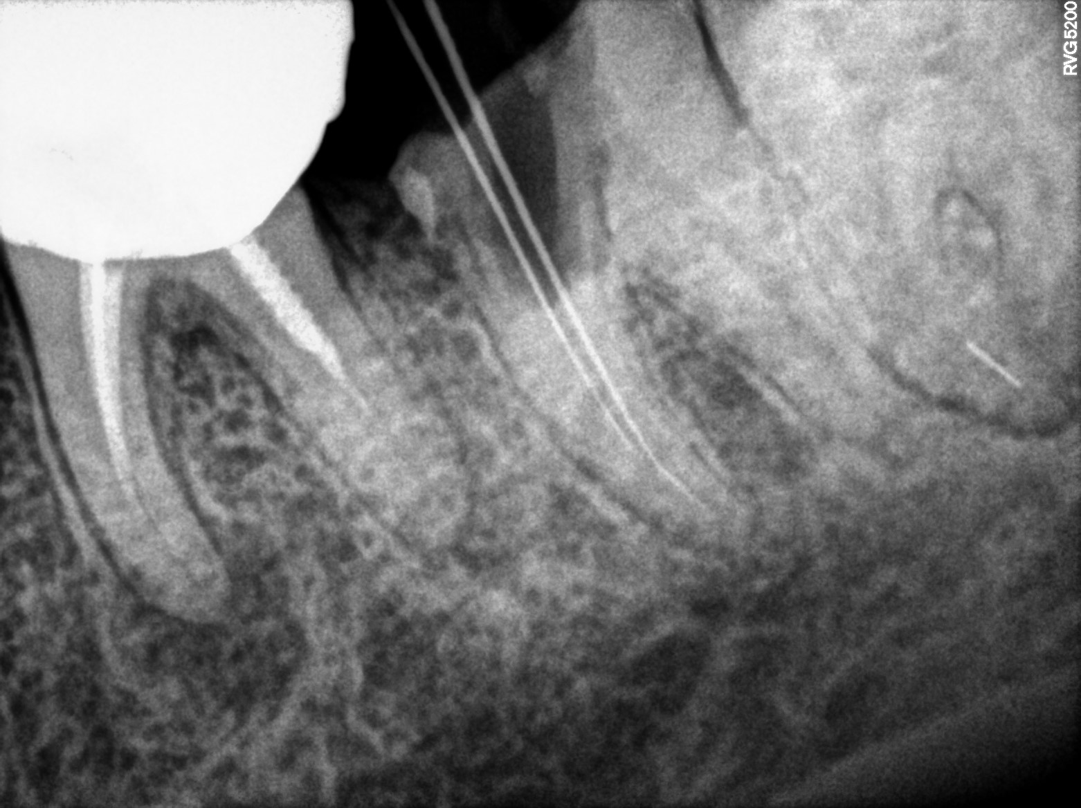 Dental X-ray
